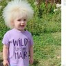 まるでタンポポの綿毛のよう「櫛でとかせない頭髪症候群」の3歳女児（英）
