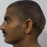 後頭部にもう一つの頭をぶら下げたような男性、15年間で巨大化した腫瘍切除（印）