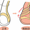 ６時間以内に緊急手術をしないと「精巣・金玉・睾丸」が失われる危険性がある「精巣捻転」とは？