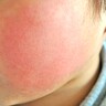 14年ぶりに「警報レベル」　静岡で広がる感染症とは？　6月以降さらに拡大の恐れ